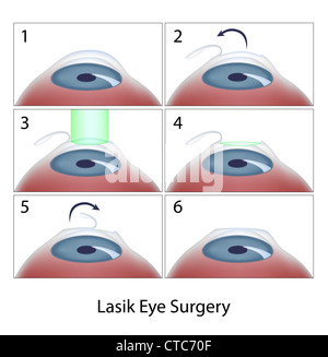 LASIK Auge Chirurgie Verfahren Stockfoto