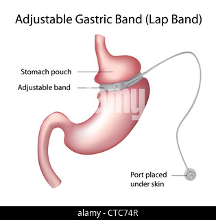 Magenband-Gewicht-Verlust-Chirurgie Stockfoto
