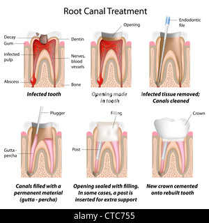 Wurzelbehandlung Stockfoto