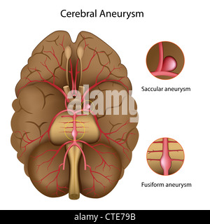 Zerebrales Aneurysma Stockfoto