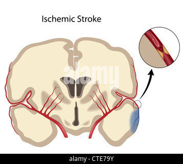 Ischämischen Schlaganfall Stockfoto