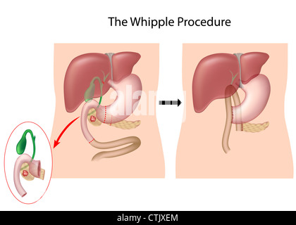 Das Whipple Verfahren zur Behandlung von Krebs in den Kopfteil der Bauchspeicheldrüse Stockfoto