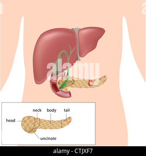 Bauchspeicheldrüsenkrebs und Diagramm von Teilen der Bauchspeicheldrüse Stockfoto