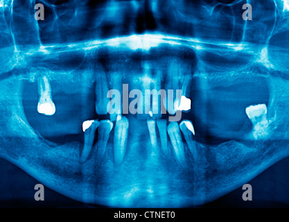 Panorex opg orthopantomogram Mund und Zähne Radiographie Stockfoto