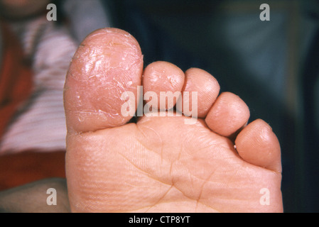 Geotrichum Pilzinfektion der Großzehe. Stockfoto