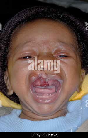 Lippen- und Gaumenspalte bei einem jungen nigerianischen baby Stockfoto