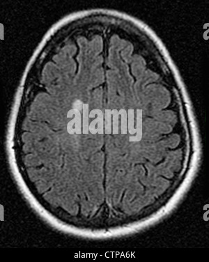 MRT zeigt Multiple Sklerose in eine 42 jährige Frau Stockfoto