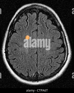 MRT zeigt Multiple Sklerose in eine 42 jährige Frau Stockfoto