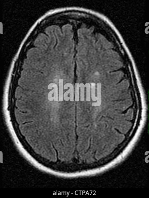 MRT zeigt Multiple Sklerose in eine 42 jährige Frau Stockfoto