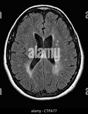 MRT zeigt Multiple Sklerose in eine 42 jährige Frau Stockfoto