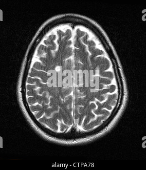 MRT zeigt Multiple Sklerose in eine 42 jährige Frau Stockfoto