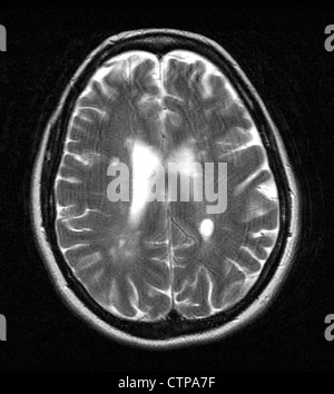 MRT zeigt Multiple Sklerose in eine 42 jährige Frau Stockfoto