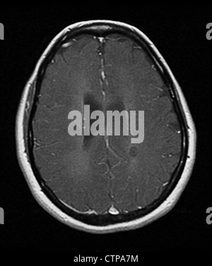 MRT zeigt Multiple Sklerose in eine 42 jährige Frau Stockfoto