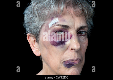 Eine ältere Großmutter schlecht geschlagen, mit Stichen, ein blaues Auge und eine dicke Lippe. Stockfoto