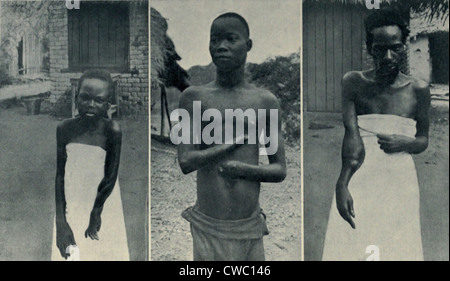 Gräueltaten der Kautschuk-Sklaverei in Belgisch-Kongo. Mongala (links) und Biasia (rechts) Arme wurden durch Schüsse von zerschlagen. Stockfoto