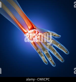 Menschliche Hand und Handgelenk Schmerzen durch Arthritis und Sport oder Karpal-Tunnel-Syndrom Verletzungen in das Hand-Gelenk als eine Anatomie mit Skelett und hervorgehobenen verletzten Körperteil als Medizin und Gesundheitswesen-Symbol. Stockfoto