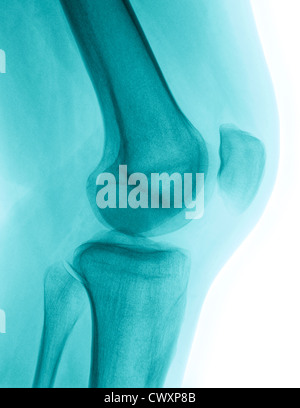 Detaillierten Röntgenbild einer gesunden menschlichen rechtes Knie. Bild erstellt mit modernen digitalen Radiographie Stockfoto