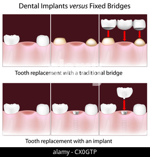 Zahnimplantate im Vergleich zu traditionellen festen Brücken Stockfoto