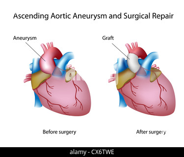 Aufsteigende Aortenaneurysma und offene Chirurgie Stockfoto