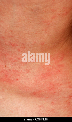 die Struktur der Haut allergische Ausschlag dermatitis Stockfoto