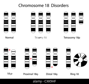 Chromosom 18 Störungen Stockfoto