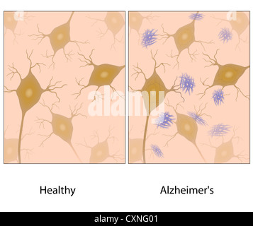 Alzheimer-Krankheit Hirngewebe mit amyloid Stockfoto