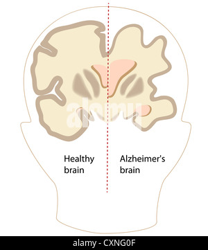 Alzheimer-Krankheit Gehirn im Vergleich zu normalen Stockfoto