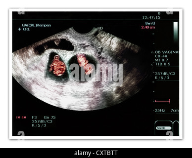 Ultraschall von einer schwangeren Frau tragen von Zwillinge Stockfoto