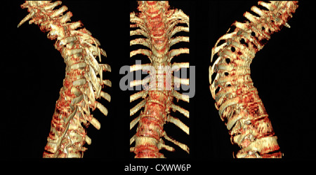 CT-Scan der Brustwirbelsäule mit Osteoporose Stockfoto