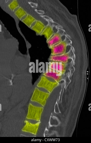 CT-Scan der Brustwirbelsäule mit Osteoporose Stockfoto