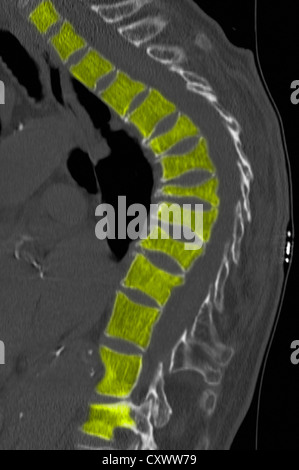 CT-Scan der Brustwirbelsäule mit Osteoporose Stockfoto