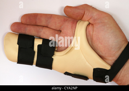 Ein Patient trägt eine Hand-Schiene nach einer Operation, einem Dupuytrens Kontraktur zu entfernen. Stockfoto