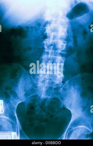 X-ray menschlichen männlichen Wirbelsäule Stockfoto