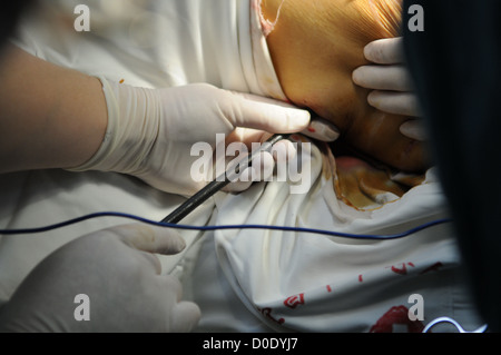 ALTE Dame überlebt Stahl SPIKE HORROR A 68 Jahre alte Dame erstaunlich überlebt einen grausamen Unfall, wenn ihre Taille durchbohrt wurde, Stockfoto