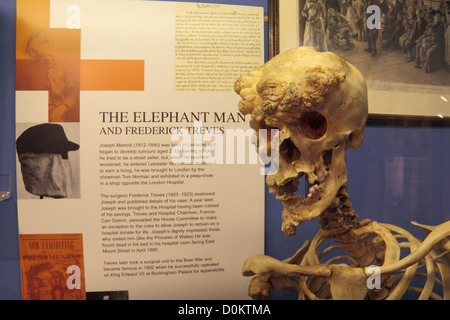 Replik des Skeletts des Joseph Merrick, Elephant Man, The Royal London Hospital Museum, Whitechapel, London, UK. Stockfoto