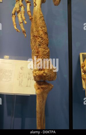 Replik des Skeletts des Joseph Merrick, Elephant Man, The Royal London Hospital Museum, Whitechapel, London, UK. Stockfoto