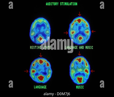 PET-Scans Reaktion des Gehirns zeigen auf auditive Reize Stockfoto