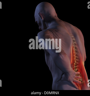 Anatomisches Modell zeigt einen entzündeten Gebiet von Rückenschmerzen betroffen. Stockfoto