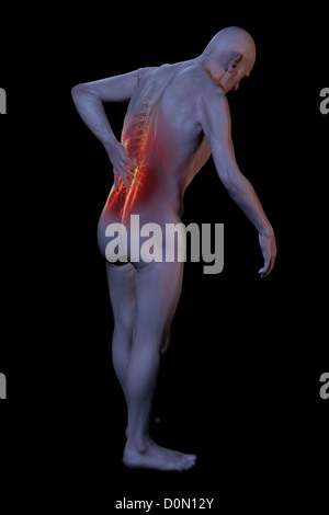 Anatomisches Modell zeigt einen entzündeten Gebiet von Rückenschmerzen betroffen. Stockfoto