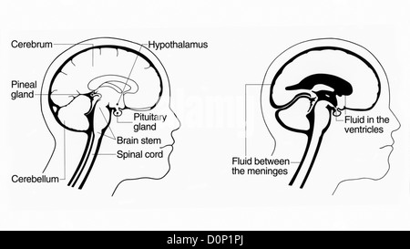Eine Cutaway Darstellung Anhaftungen Hirnwasser Gehirntumor in Gehirn Wirbelsäule verursacht. Verschiedene Teile Gehirn sind beschriftet. Stockfoto