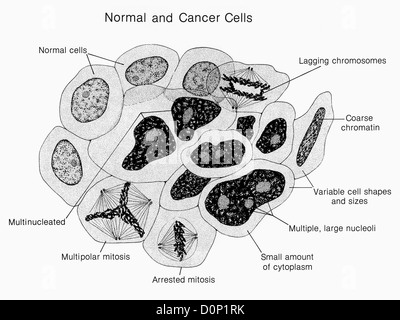 Des Künstlers Krebszellen Wiedergabe normalen Side-by-Side. normale krebsige Eigenschaften sind gekennzeichnet. Abbildung Pat Kenny. Stockfoto