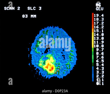 Ein PET-Scan (Positronen-Emissions-Tomographie) 62 Jahre alt Mann Hirntumor als Klasse III Astrozytom eingestuft. PET-Scan zeigt Stockfoto