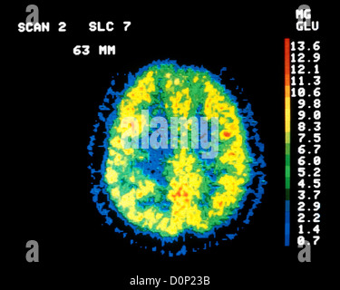 Stellung Emissions-Tomographie (PET) zerebrale Glucoseverwertung in normalen Individuum. Diese Tomogramm ist durch Oberteil Stockfoto
