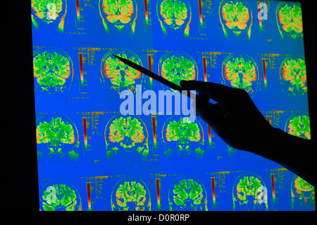 farbige Röntgenbilder der Großhirnrinde Kleinhirn menschliche Gehirn MRI Stockfoto