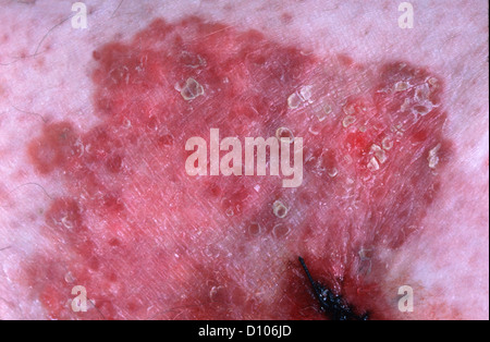 MORBUS BOWEN Stockfoto, Bild: 84545912 - Alamy
