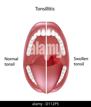 Mandelentzündung Stockfoto
