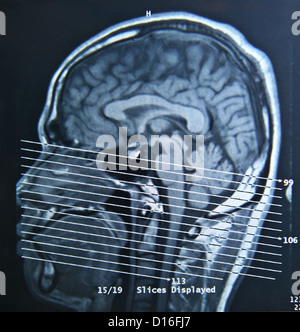 Ein Magnet-Resonanz-Tomographie Scan des menschlichen Gehirns. Stockfoto