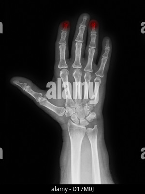 Röntgenaufnahme der Hand mit zerkleinerten Zeigefinger Stockfoto