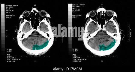 CT-Scan des älteren Menschen mit alten okzipitalen Infarkt Stockfoto