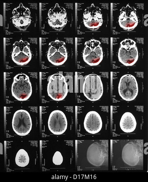 CT-Scan des älteren Menschen mit alten okzipitalen Infarkt Stockfoto